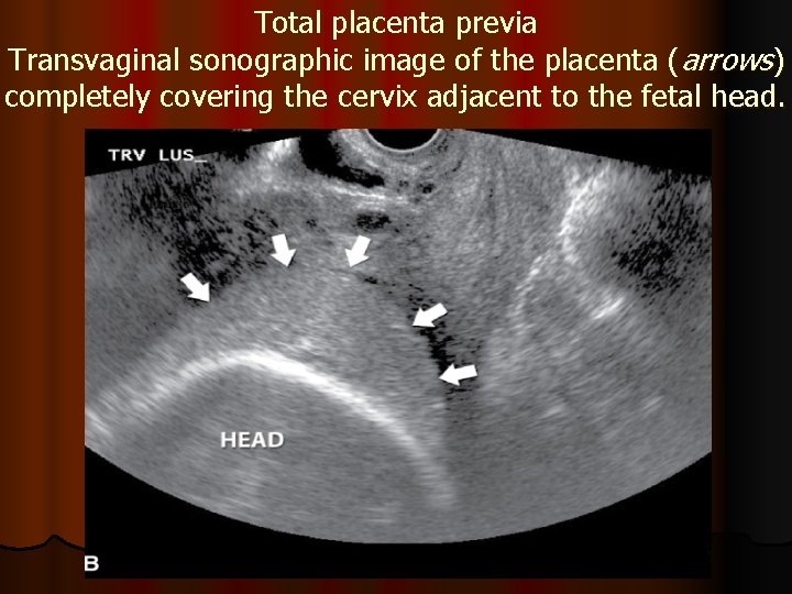 Total placenta previa Transvaginal sonographic image of the placenta (arrows) completely covering the cervix