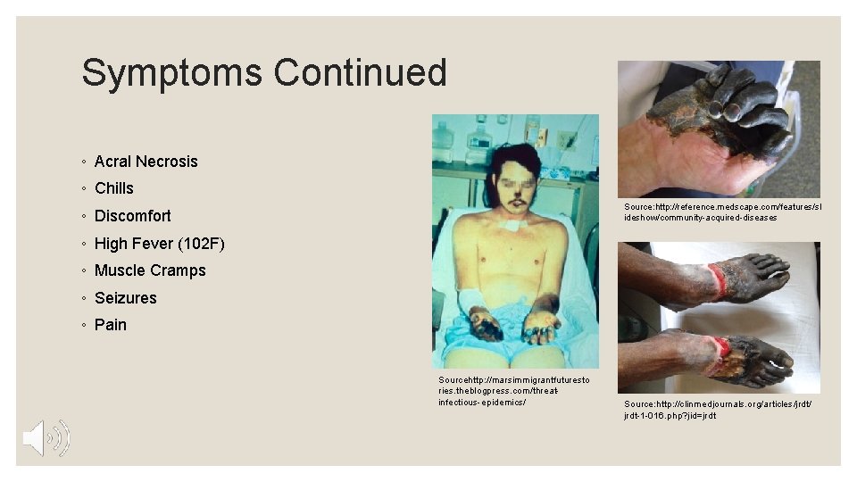 Symptoms Continued ◦ Acral Necrosis ◦ Chills Source: http: //reference. medscape. com/features/sl ideshow/community-acquired-diseases ◦