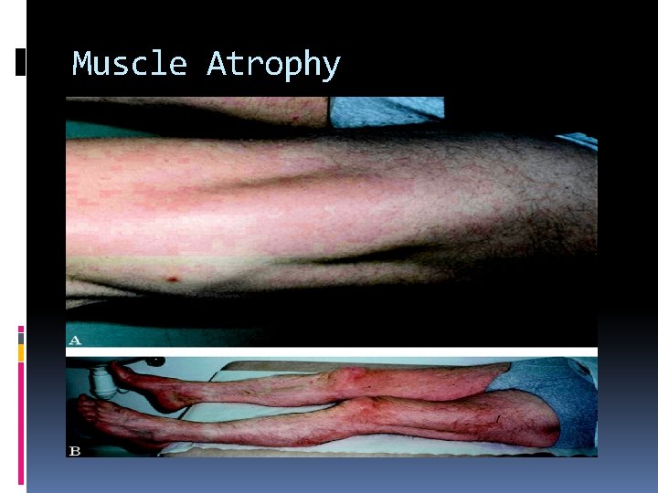 Muscle Atrophy 