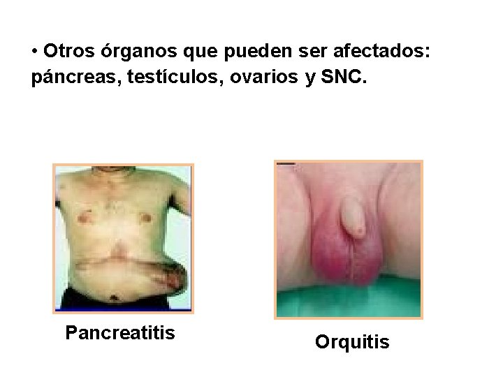  • Otros órganos que pueden ser afectados: páncreas, testículos, ovarios y SNC. Pancreatitis
