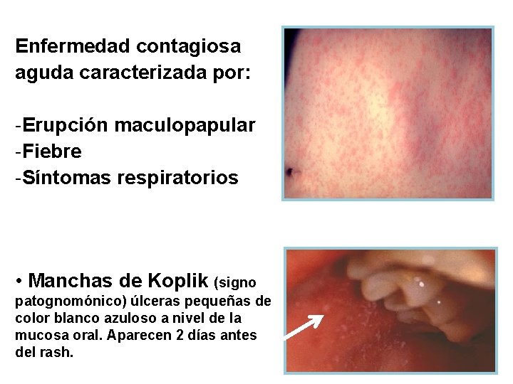 Enfermedad contagiosa aguda caracterizada por: -Erupción maculopapular -Fiebre -Síntomas respiratorios • Manchas de Koplik