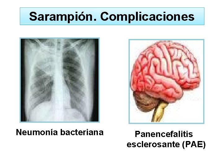 Sarampión. Complicaciones Neumonía bacteriana Panencefalitis esclerosante (PAE) 