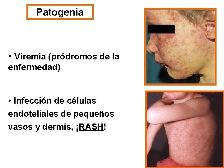 Patogenia • Viremia (pródromos de la enfermedad) • Infección de células endoteliales de pequeños