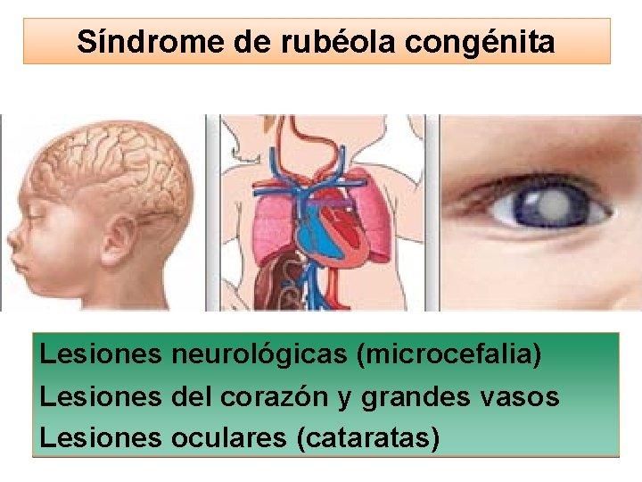 Síndrome de rubéola congénita Lesiones neurológicas (microcefalia) Lesiones del corazón y grandes vasos Lesiones