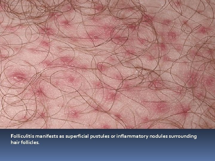 Folliculitis manifests as superficial pustules or inflammatory nodules surrounding hair follicles. 