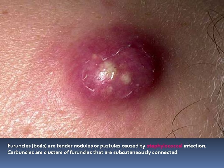 Furuncles (boils) are tender nodules or pustules caused by staphylococcal infection. Carbuncles are clusters