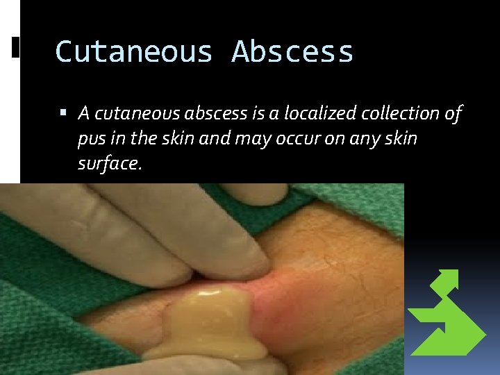 Cutaneous Abscess A cutaneous abscess is a localized collection of pus in the skin