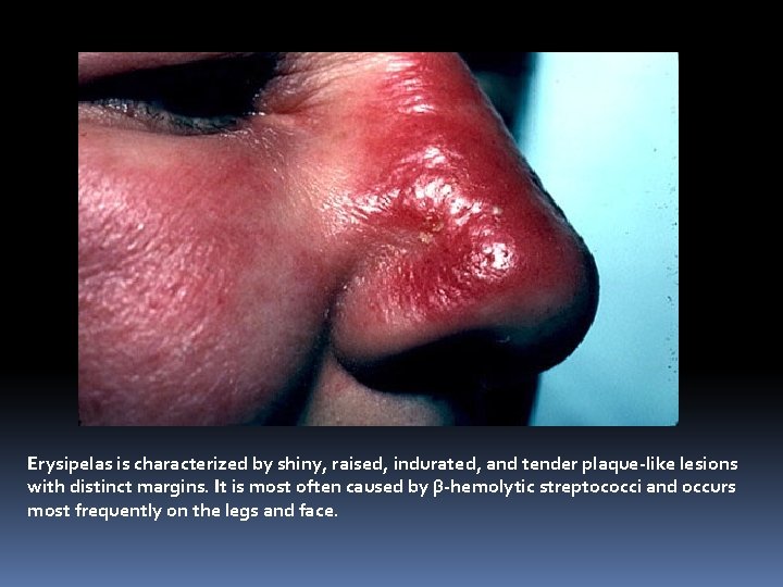 Erysipelas is characterized by shiny, raised, indurated, and tender plaque-like lesions with distinct margins.