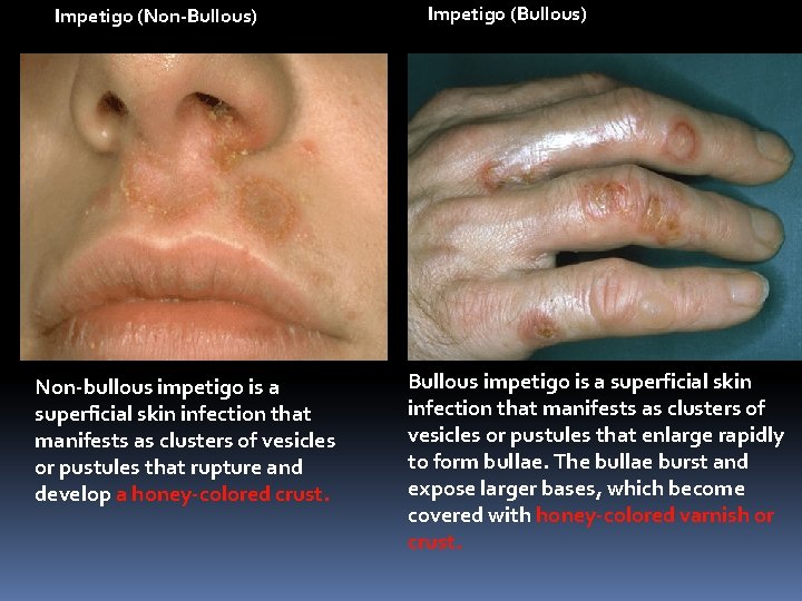Impetigo (Non-Bullous) Non-bullous impetigo is a superficial skin infection that manifests as clusters of