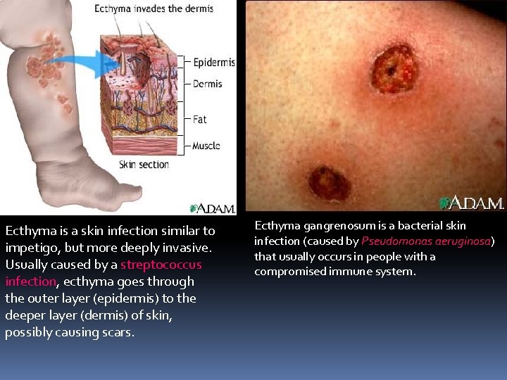 Ecthyma is a skin infection similar to impetigo, but more deeply invasive. Usually caused