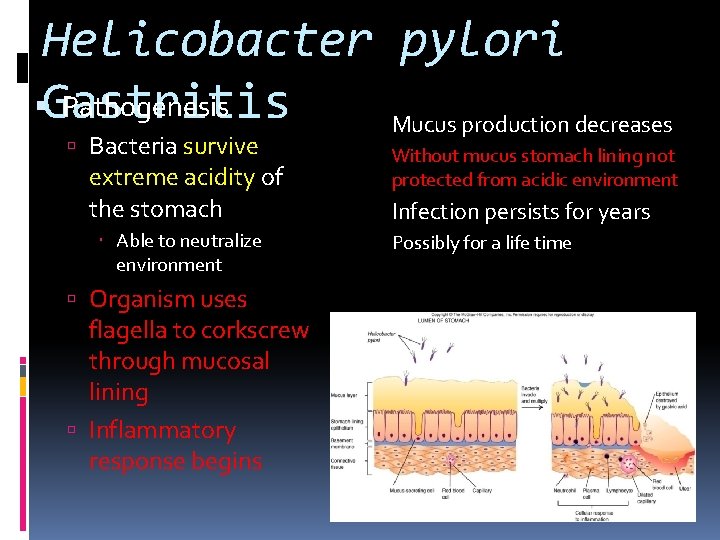 Helicobacter pylori Gastritis Pathogenesis – Mucus production decreases Bacteria survive extreme acidity of the