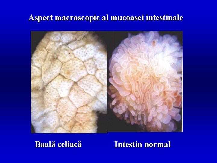 Aspect macroscopic al mucoasei intestinale Boală celiacă Intestin normal 