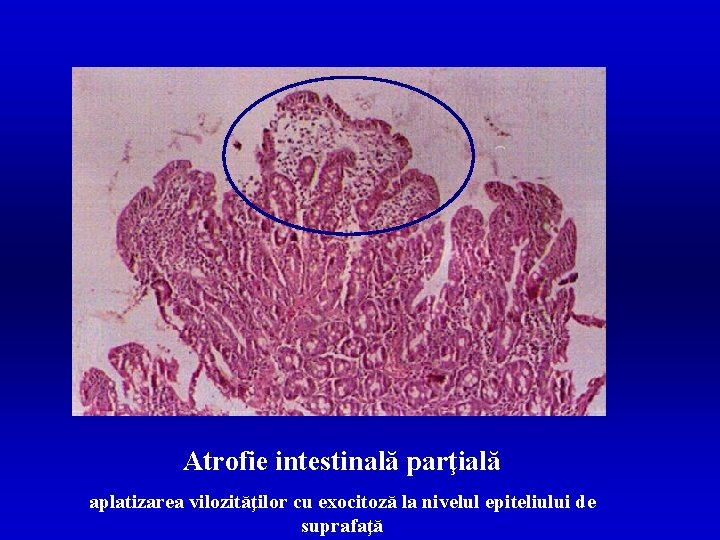 Atrofie intestinală parţială aplatizarea vilozităţilor cu exocitoză la nivelul epiteliului de suprafaţă 