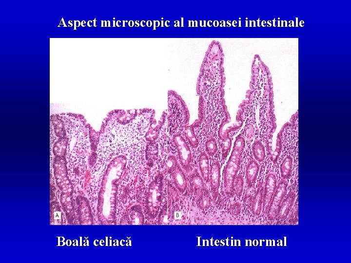 Aspect microscopic al mucoasei intestinale Boală celiacă Intestin normal 