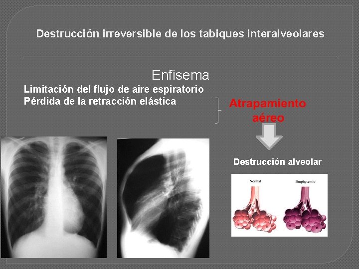 Destrucción irreversible de los tabiques interalveolares Enfisema Limitación del flujo de aire espiratorio Pérdida