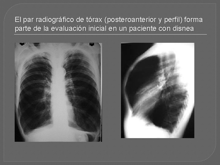 El par radiográfico de tórax (posteroanterior y perfil) forma parte de la evaluación inicial
