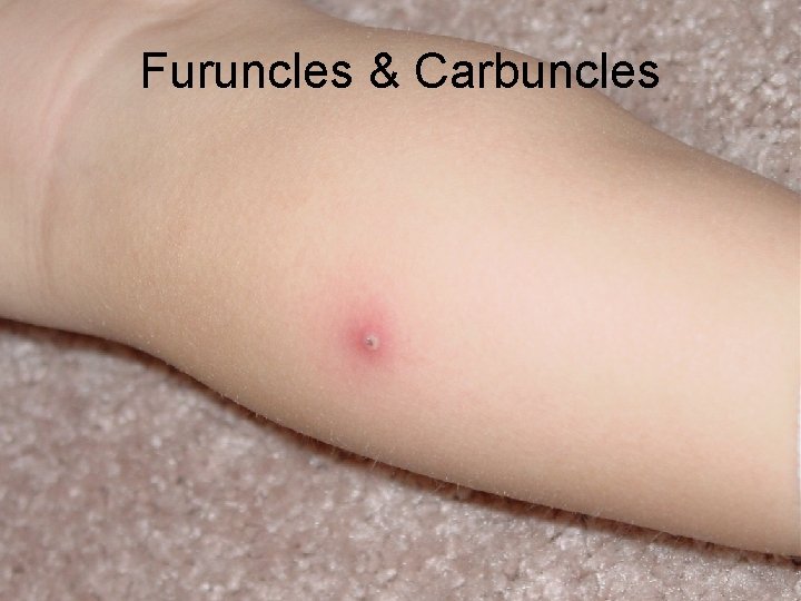 Furuncles & Carbuncles 