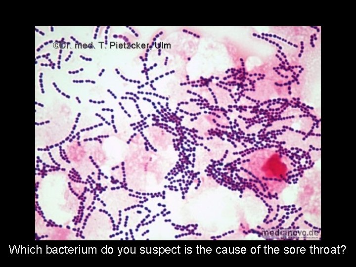 Which bacterium do you suspect is the cause of the sore throat? 