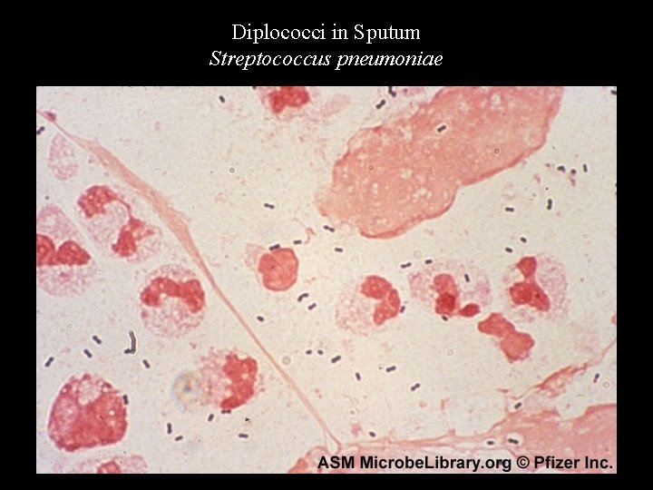 Diplococci in Sputum Streptococcus pneumoniae 