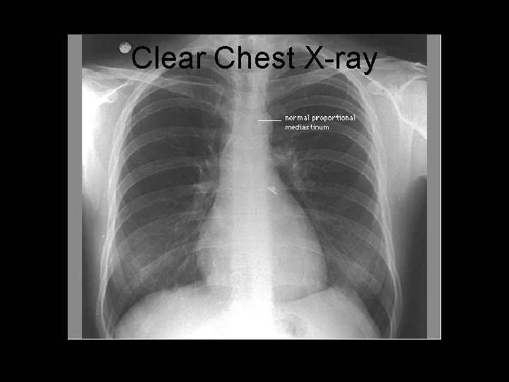 Clear Chest X-ray 