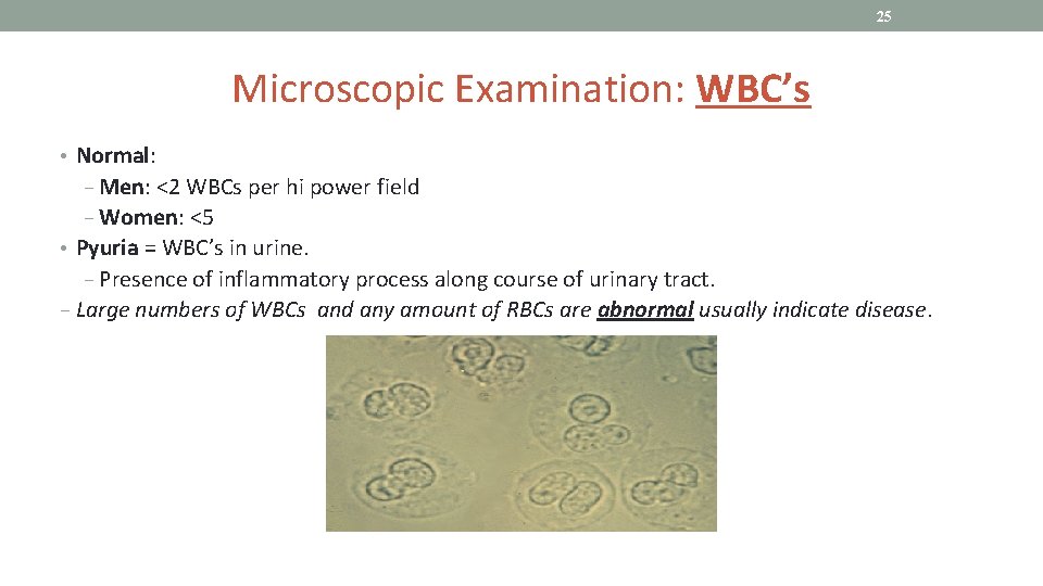 25 Microscopic Examination: WBC’s • Normal: − Men: <2 WBCs per hi power field