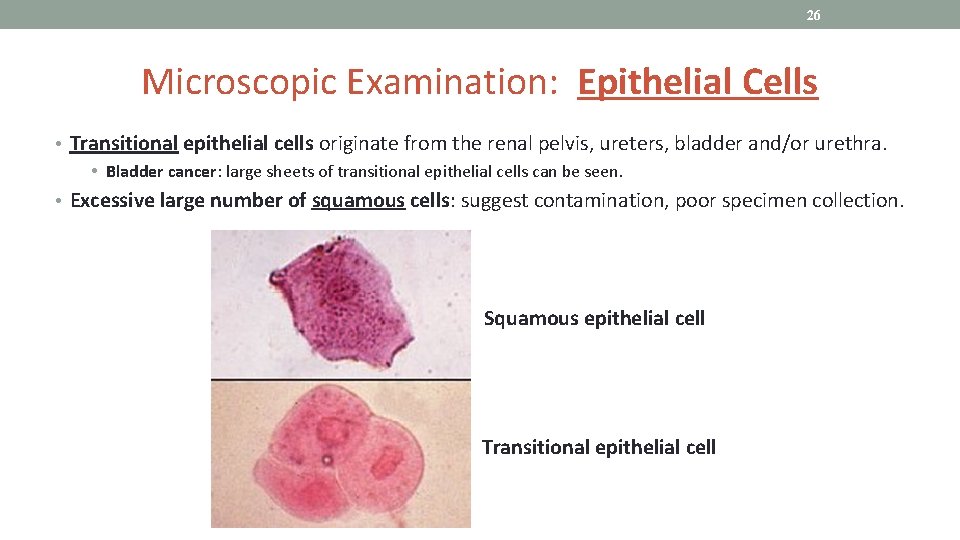 26 Microscopic Examination: Epithelial Cells • Transitional epithelial cells originate from the renal pelvis,