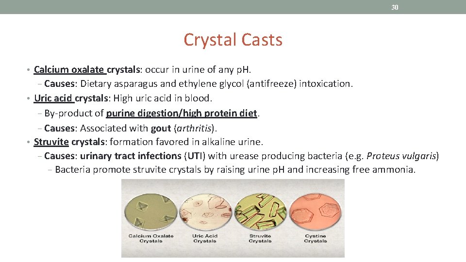 30 Crystal Casts • Calcium oxalate crystals: occur in urine of any p. H.