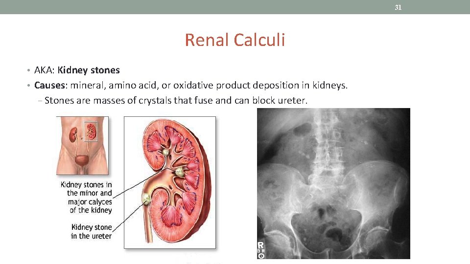 31 Renal Calculi • AKA: Kidney stones • Causes: mineral, amino acid, or oxidative