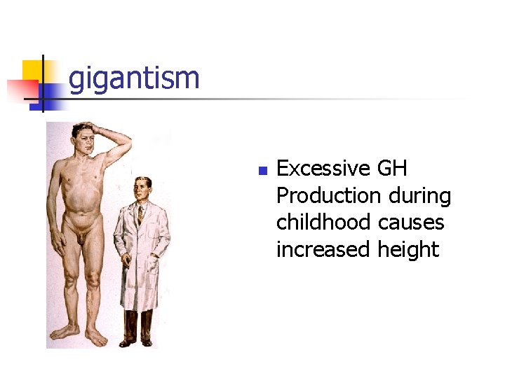 gigantism n Excessive GH Production during childhood causes increased height 