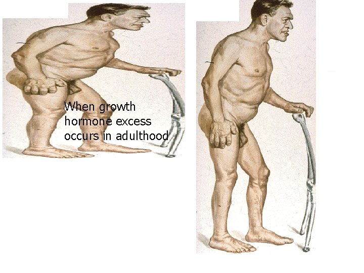 acromegaly When growth hormone excess occurs in adulthood 