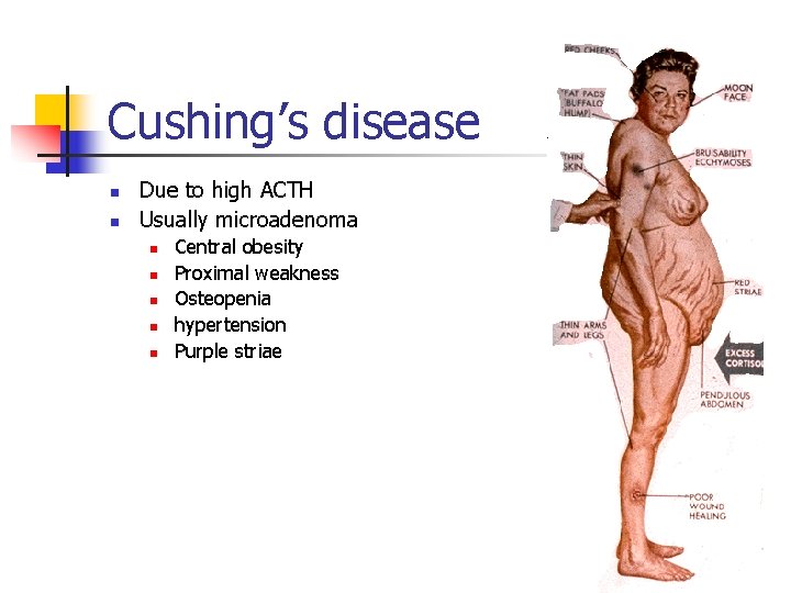 Cushing’s disease n n Due to high ACTH Usually microadenoma n n n Central