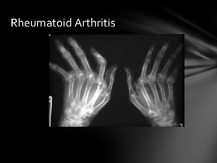 Rheumatoid Arthritis 