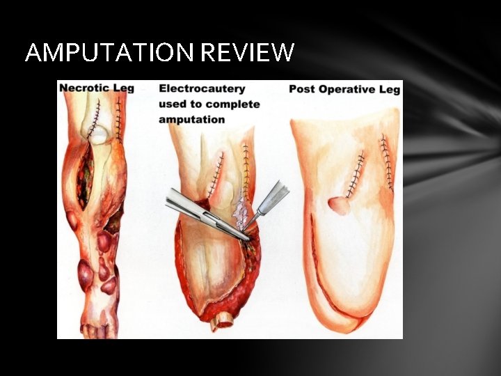AMPUTATION REVIEW 