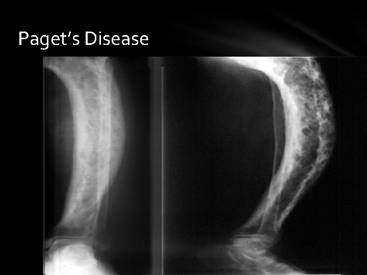 Paget’s Disease 