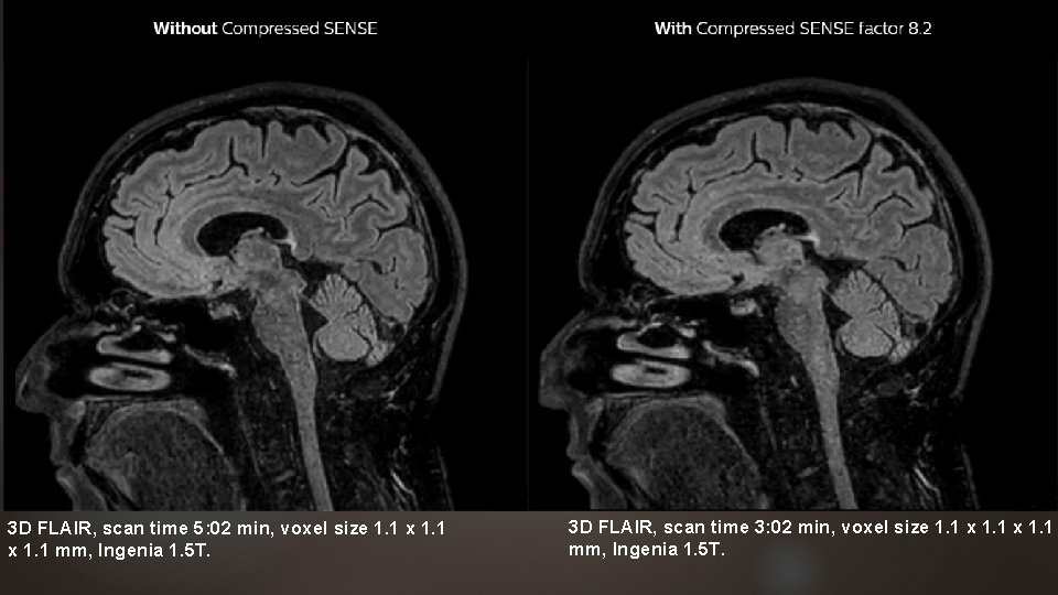 3 D FLAIR, scan time 5: 02 min, voxel size 1. 1 x 1.