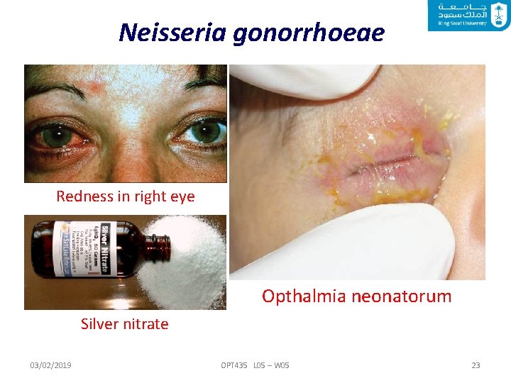 Neisseria gonorrhoeae Redness in right eye Opthalmia neonatorum Silver nitrate 03/02/2019 OPT 435 L