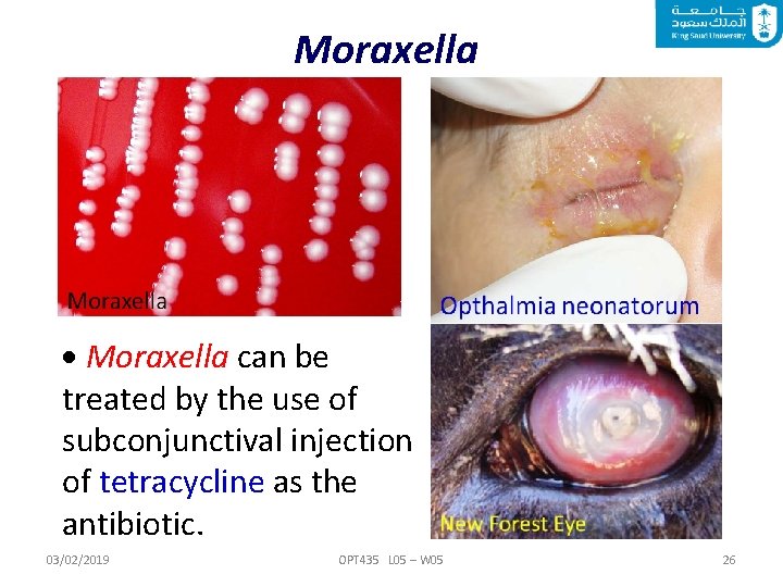 Moraxella can be treated by the use of subconjunctival injection of tetracycline as the
