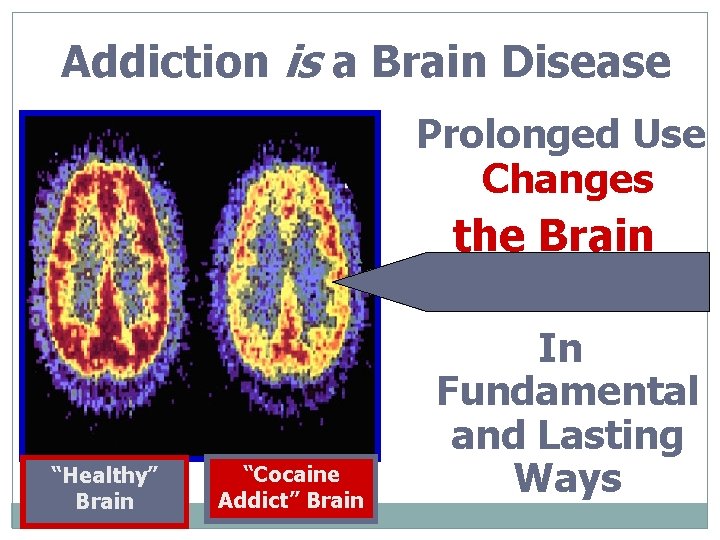 Addiction is a Brain Disease Prolonged Use Changes the Brain n “Healthy” Brain “Cocaine