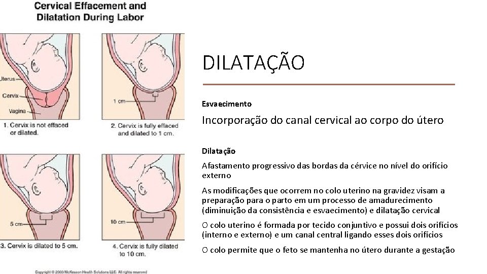 DILATAÇÃO Esvaecimento Incorporação do canal cervical ao corpo do útero Dilatação Afastamento progressivo das