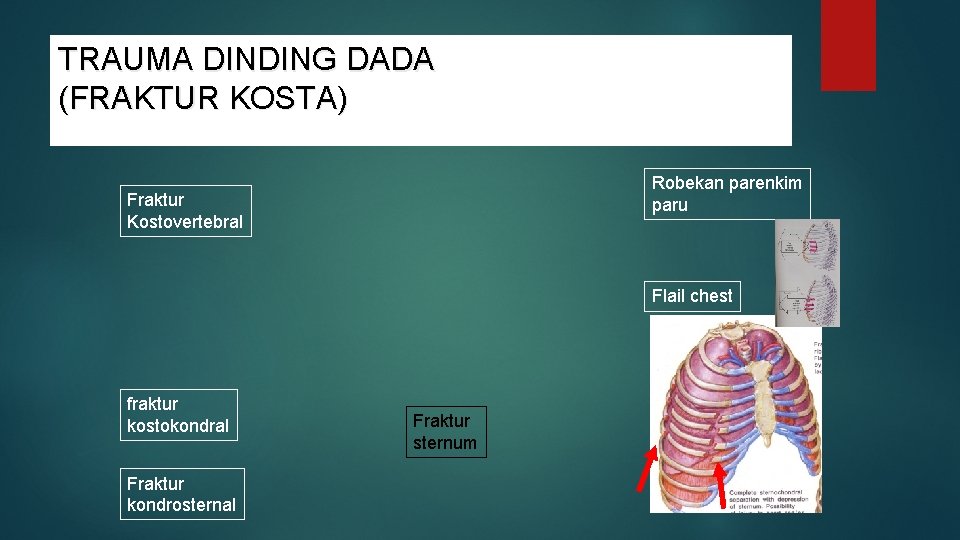 TRAUMA DINDING DADA (FRAKTUR KOSTA) Robekan parenkim paru Fraktur Kostovertebral Flail chest fraktur kostokondral