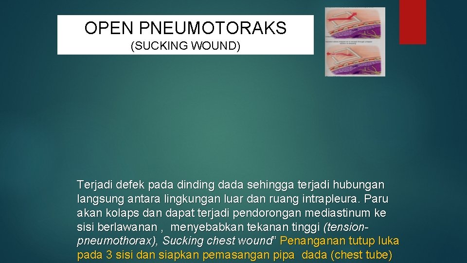 OPEN PNEUMOTORAKS (SUCKING WOUND) Terjadi defek pada dinding dada sehingga terjadi hubungan langsung antara