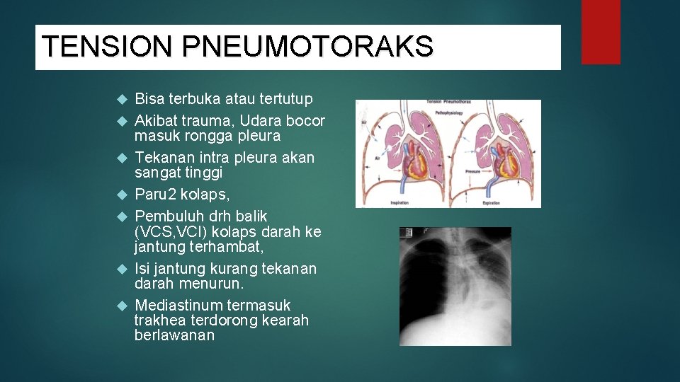 TENSION PNEUMOTORAKS Bisa terbuka atau tertutup Akibat trauma, Udara bocor masuk rongga pleura Tekanan