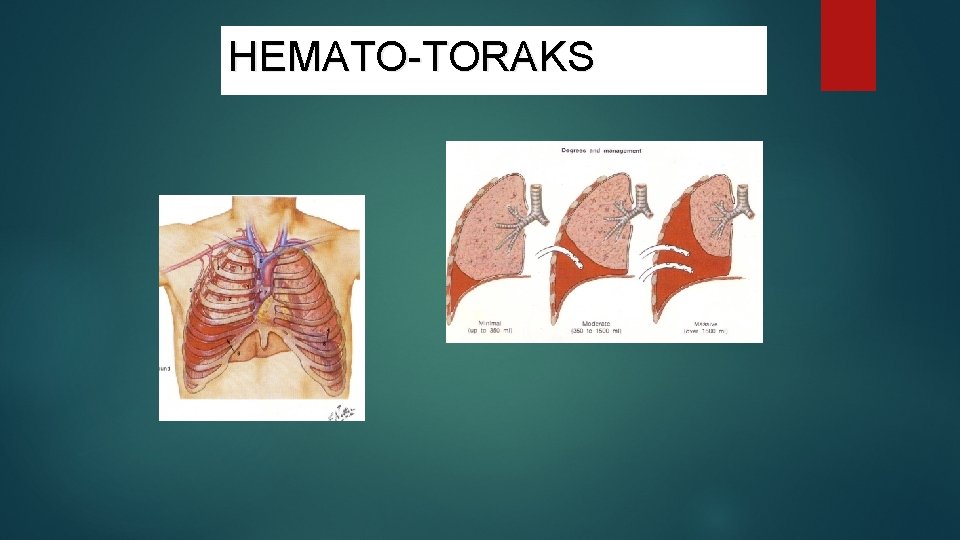 HEMATO-TORAKS 