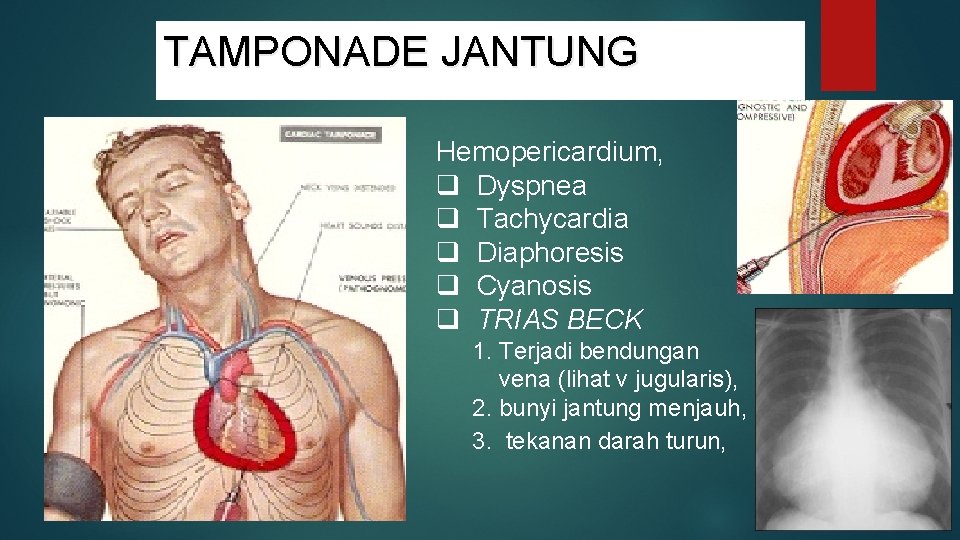 TAMPONADE JANTUNG Hemopericardium, q Dyspnea q Tachycardia q Diaphoresis q Cyanosis q TRIAS BECK