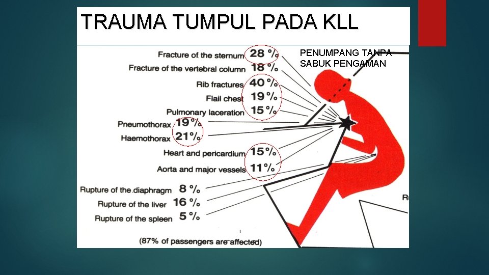 TRAUMA TUMPUL PADA KLL PENUMPANG TANPA SABUK PENGAMAN 