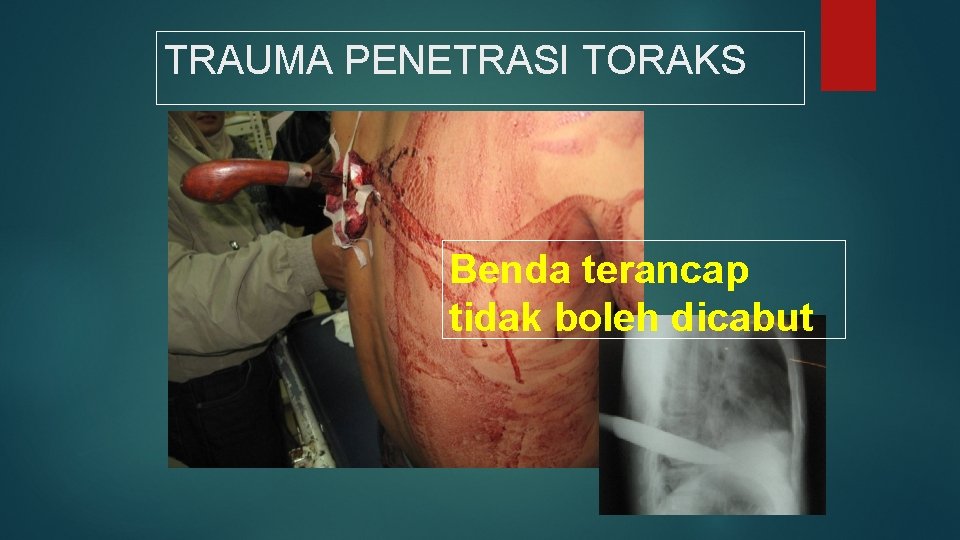 TRAUMA PENETRASI TORAKS Benda terancap tidak boleh dicabut 