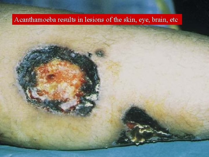 Acanthamoeba results in lesions of the skin, eye, brain, etc. 