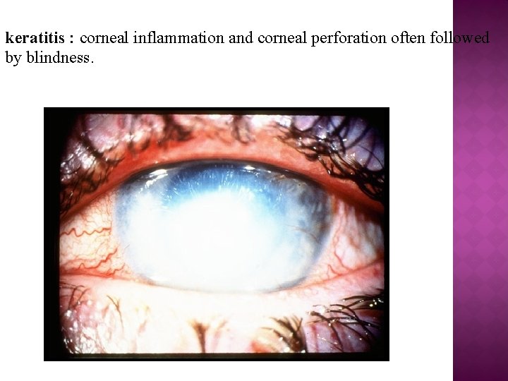 keratitis : corneal inflammation and corneal perforation often followed by blindness. 