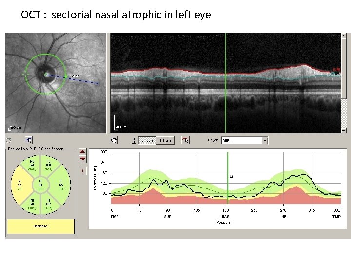 OCT : sectorial nasal atrophic in left eye 