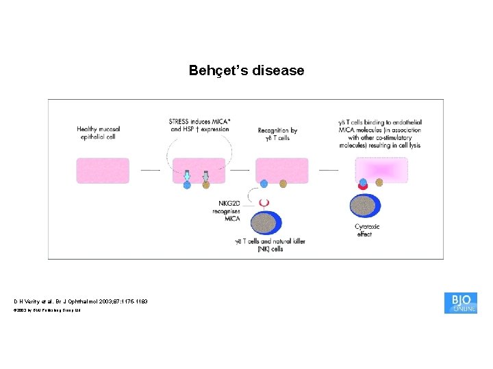 Behçet’s disease D H Verity et al. Br J Ophthalmol 2003; 87: 1175 -1183